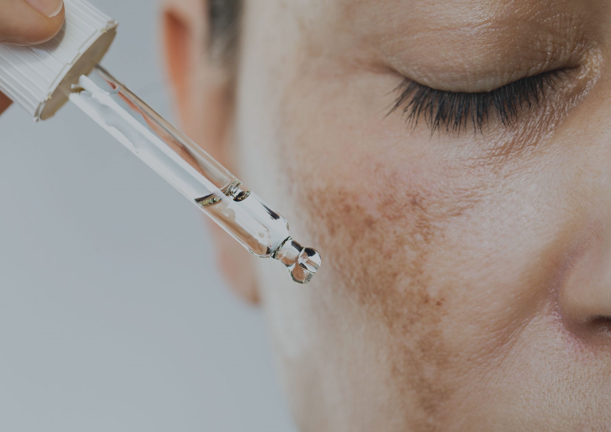 Face suffering with hyperpigmentation Face suffering with hyperpigmentation